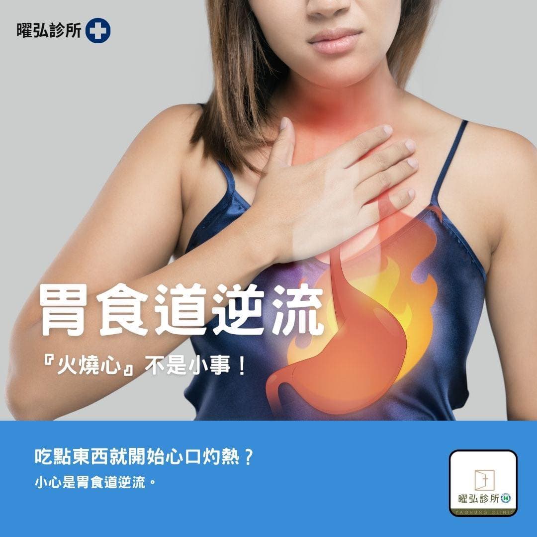 胃食道逆流 —「火燒心」不是小事‼️