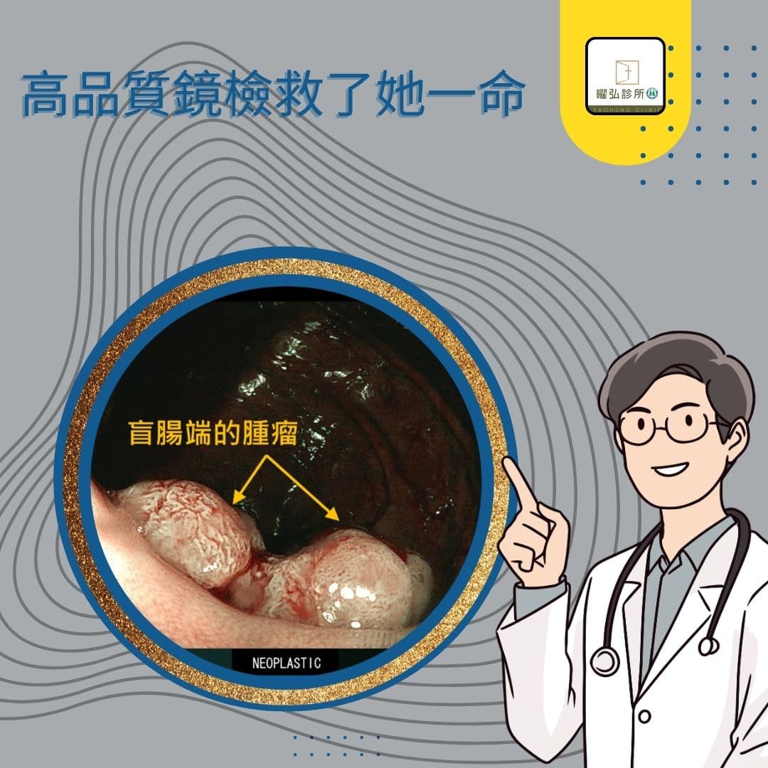 【⚠ 隱藏在末端的大腸腫瘤,高品質鏡檢救了她一命】